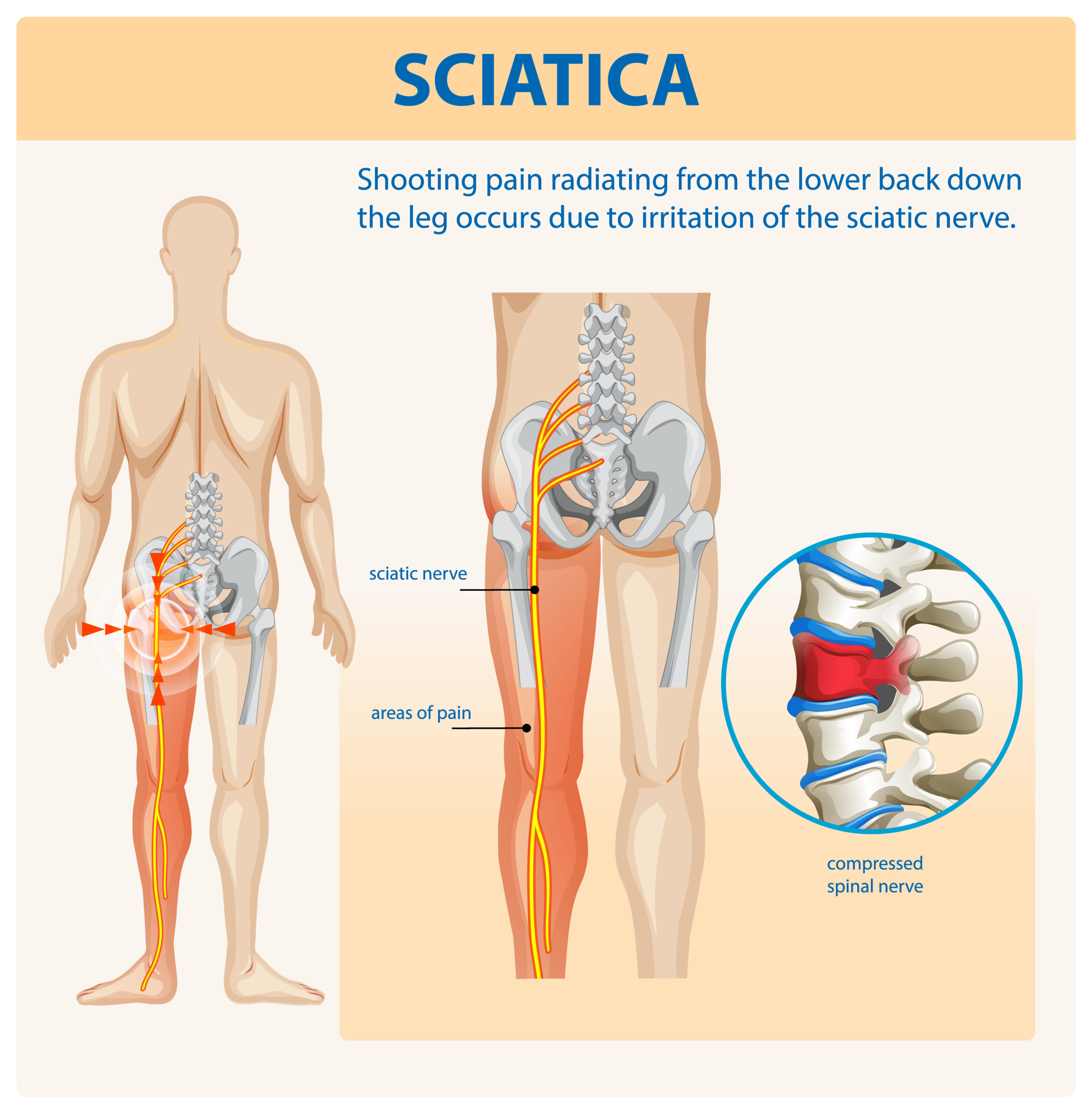 Understanding sciatica to answer the question "can foot reflexology help Sciatica pain"